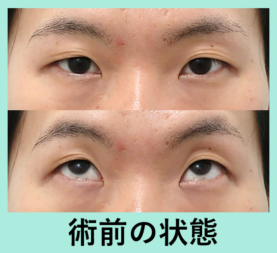 『皮膚のたるみも眼瞼下垂も強い方の二重切開施術をご紹介』の画像