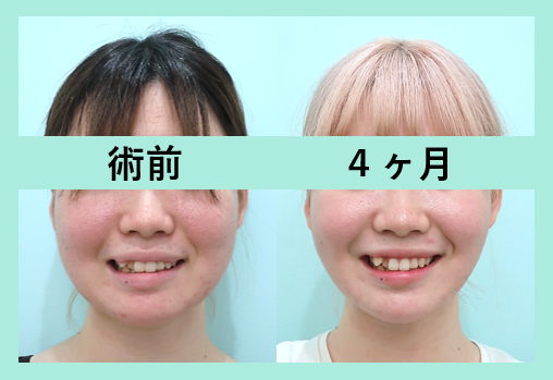 頬顎下脂肪吸引＋バッカルファット＋エラボトックス_術後４ヶ月
