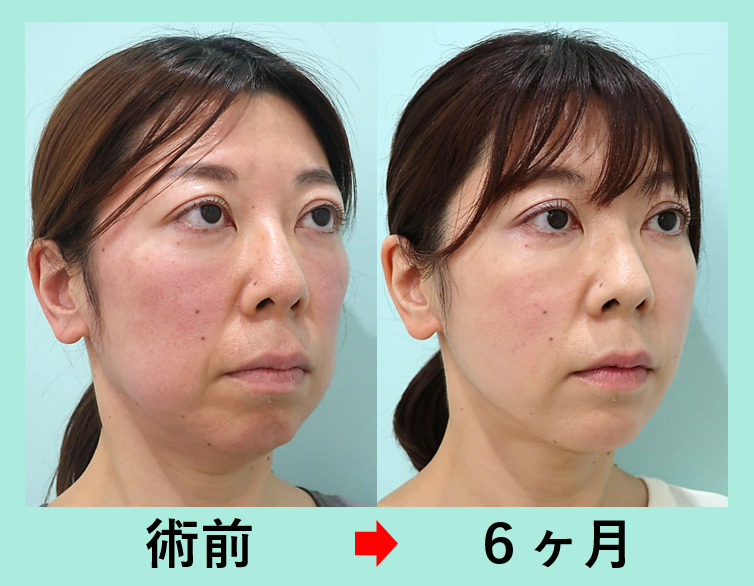 歯肉輪郭形成とは何ですか?