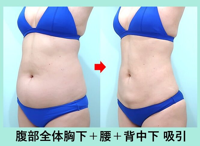 腹部全体＋胸下＋腰＋背中下の脂肪吸引_ビフォーアフター