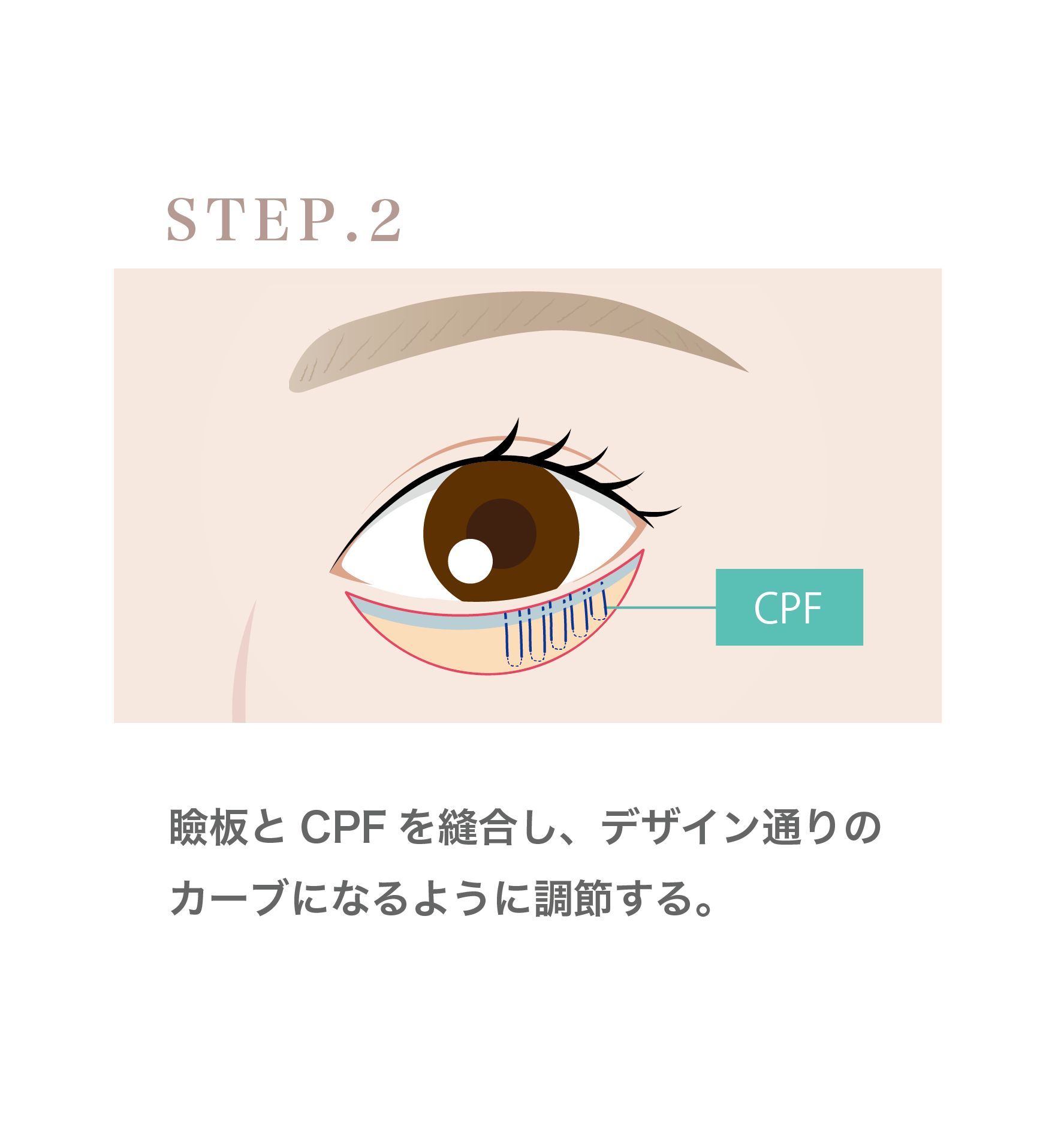 『直後からカラコン使用可能!!左右差も調整した下眼瞼下制術 (グラマラス形成) のダウンタイムを解説』の画像