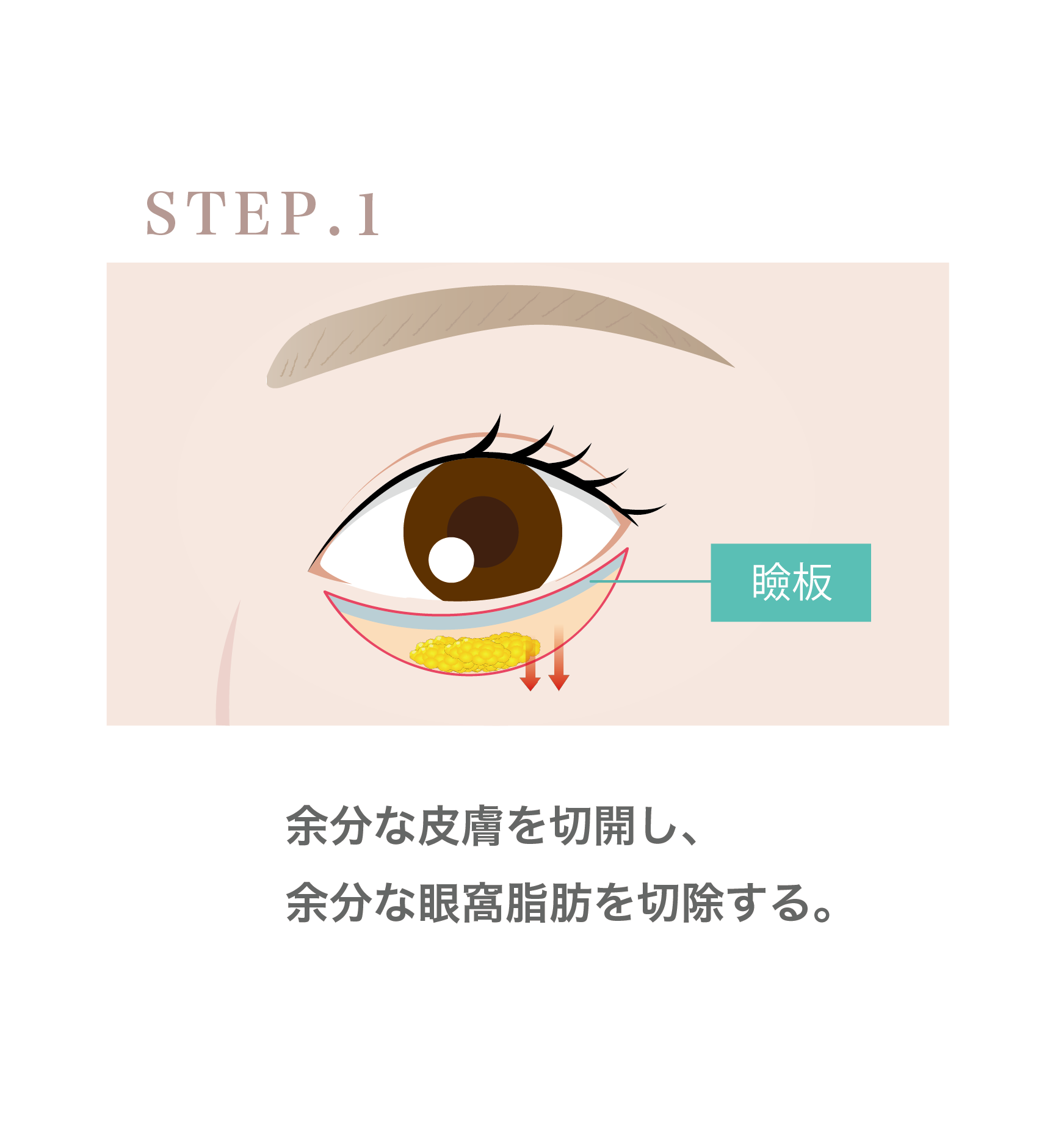 『直後からカラコン使用可能!!左右差も調整した下眼瞼下制術 (グラマラス形成) のダウンタイムを解説』の画像