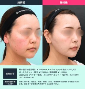 小顔治療のビフォーアフター01