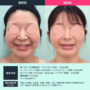 小顔治療のビフォーアフター02