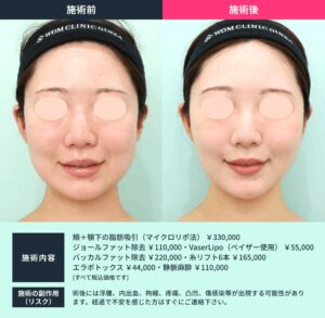 小顔治療のビフォーアフター03