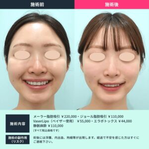 小顔治療のビフォーアフター04