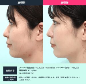 小顔治療のビフォーアフター05