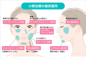 小顔治療の施術箇所と内容の説明図