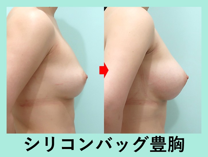 『『 シリコンバッグ豊胸＋副乳脂肪吸引 』の組み合わせ治療』の画像