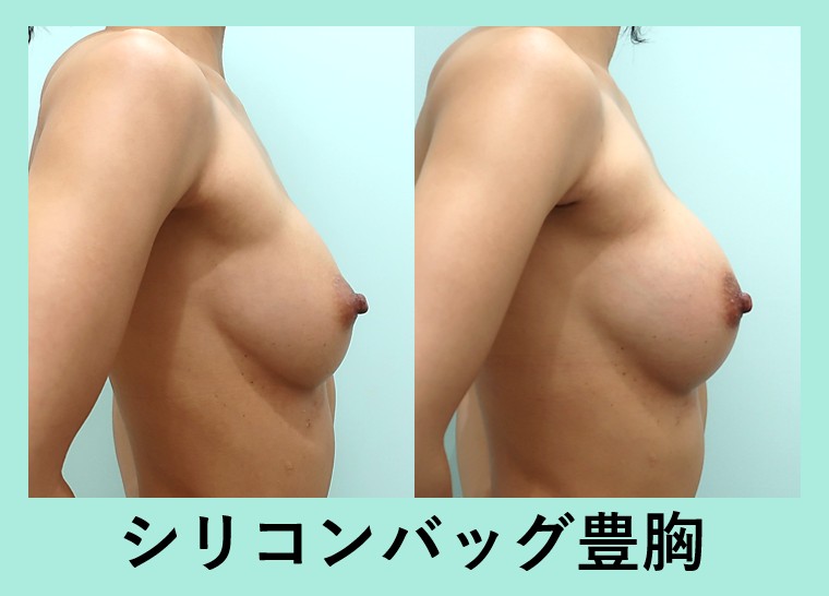 『エロさはやっぱり『 シリコン 』最小ダウンタイムのシリコンバッグ豊胸手術で憧れの胸を手に入れましょう！』の画像