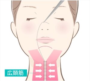 ペリカン手術の施術範囲