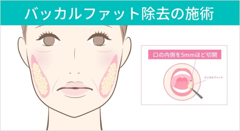 バッカルファット除去の施術と口内切開のイラスト