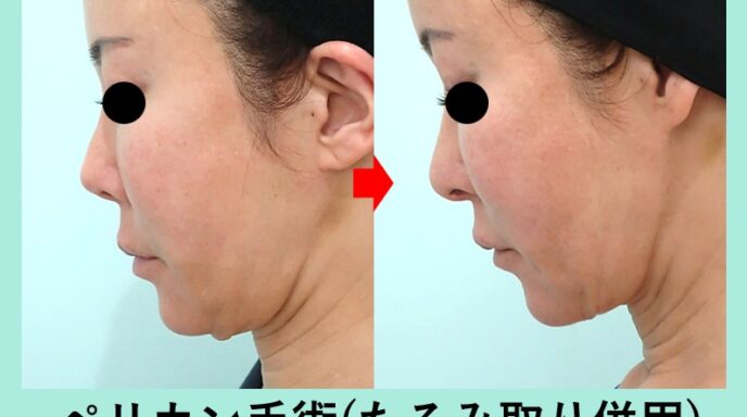 ペリカン手術_ビフォーアフター