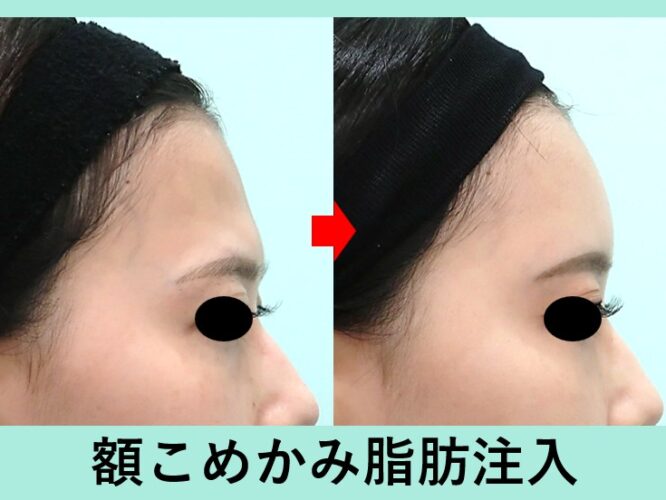 額こめかみ脂肪注入_ビフォーアフター