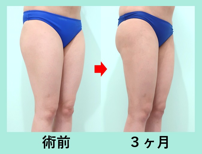 『高難度！ デコボコになりがちな「太もも全周＋膝」の脂肪吸引のポイントを解説！』の画像