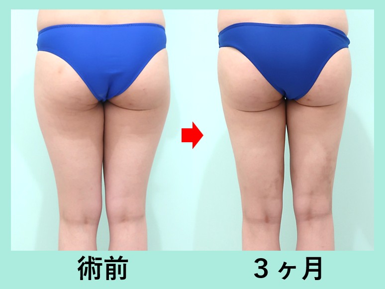 『高難度！ デコボコになりがちな「太もも全周＋膝」の脂肪吸引のポイントを解説！』の画像