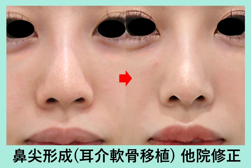 『他院手術で歪んだ鼻も、鼻尖形成術（ストラット法）で綺麗に修正できます！』の画像
