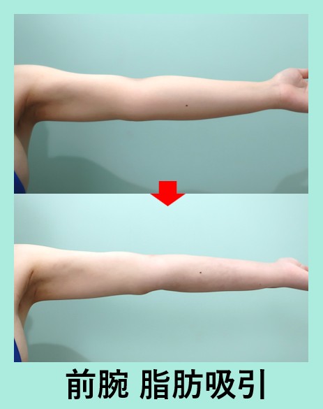 『超レア部位「肘～前腕」の脂肪吸引！この部位の症例数はトップクラスです』の画像