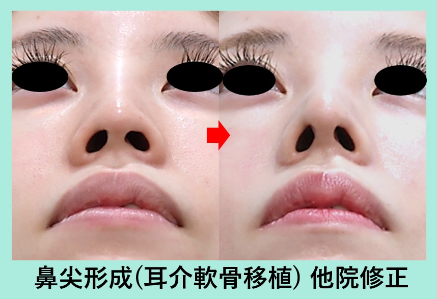 『他院手術で歪んだ鼻も、鼻尖形成術（ストラット法）で綺麗に修正できます！』の画像
