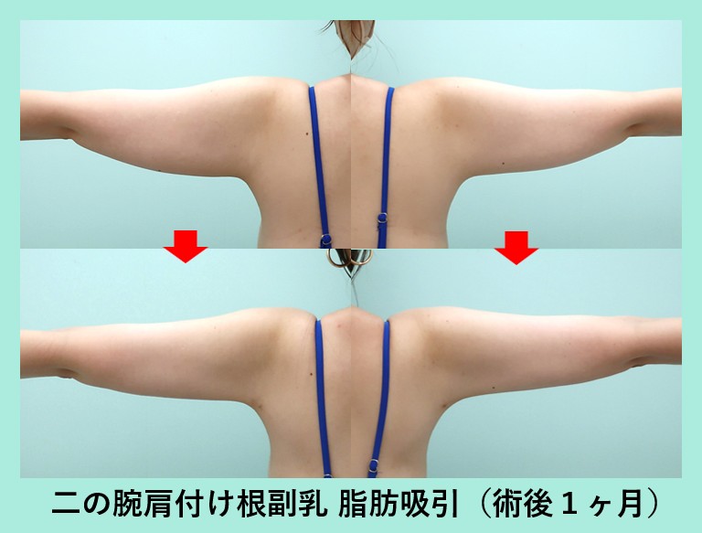 『人気の『 副乳＋二の腕 』同時手術！衝撃の変化量！』の画像
