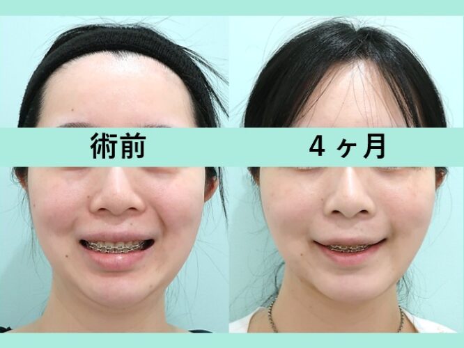 ほほあご下＋メーラー＋ジョール脂肪吸引＋糸リフト_術後4ヶ月ビフォーアフター