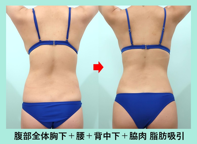 『無駄な痩身美容するくらいなら、いっそのこと、確実に細くなる超広範囲の脂肪吸引も、一つの解決策ですよね！』の画像
