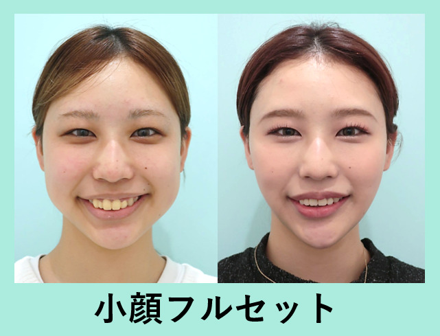 バッカルファット除去と小顔治療を組み合わせた症例写真