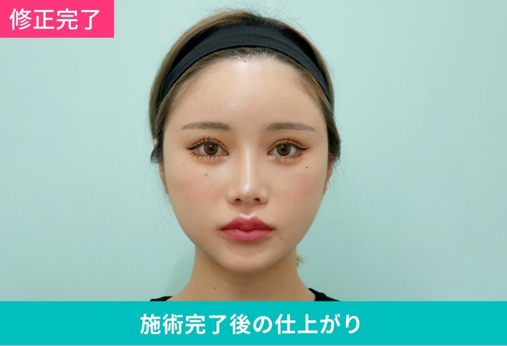 施術完了後の仕上がりの写真