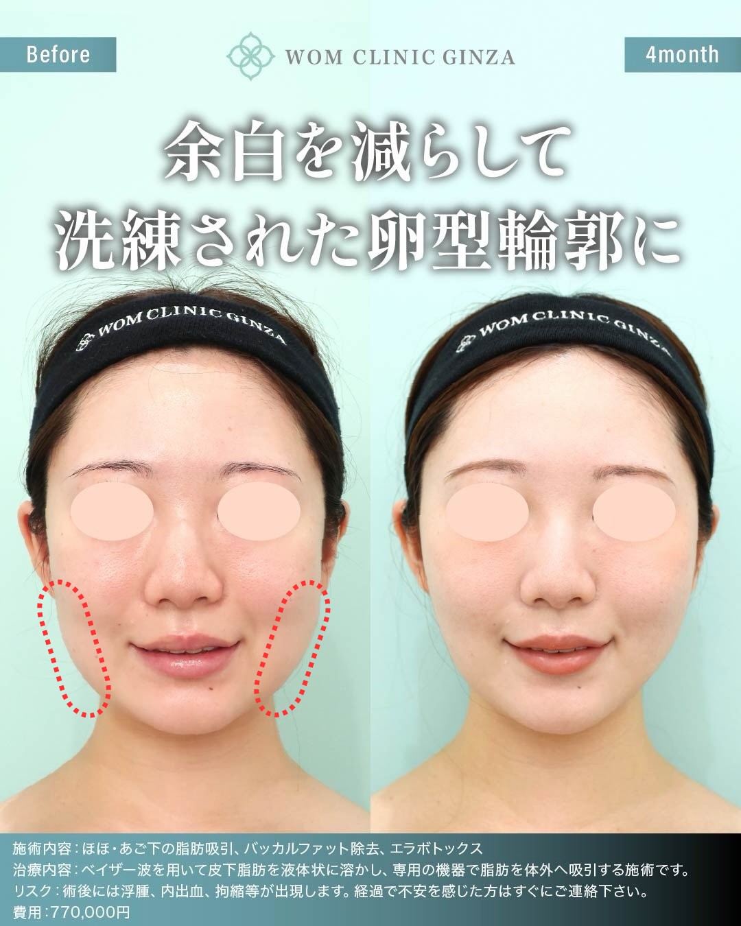 バッカルファット除去の施術範囲とビフォーアフター