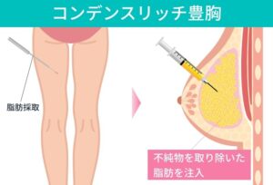 コンデンスリッチ豊胸