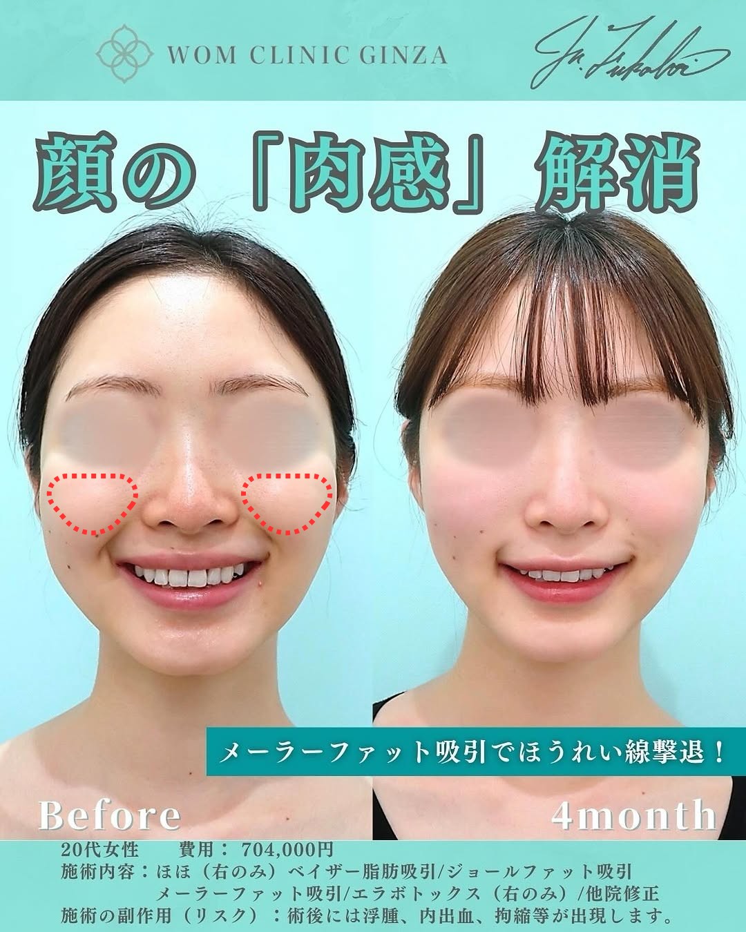 メーラーファット除去の施術範囲とビフォーアフター