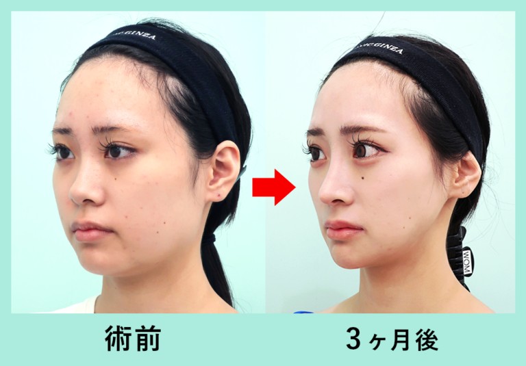 骨切り3点と脂肪吸引併用のビフォーアフター（横顔）