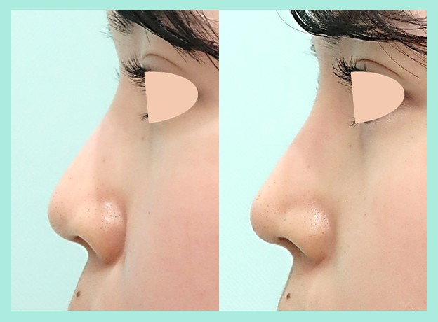『あなたに合った鼻整形は何と何？ 鼻の整形は選択肢が複雑多岐で、とても分かりにくい！』の画像