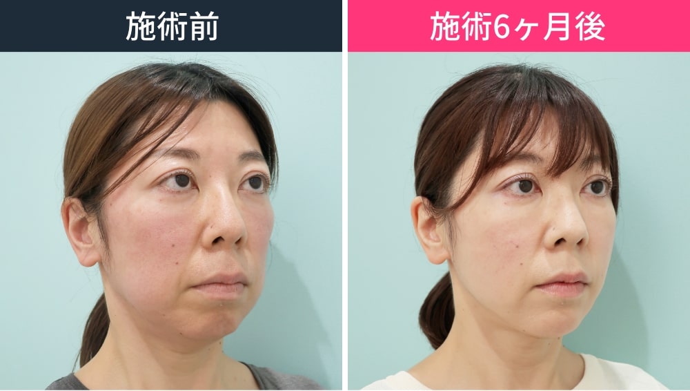 小顔とたるみの改善を両立させた施術の施術写真