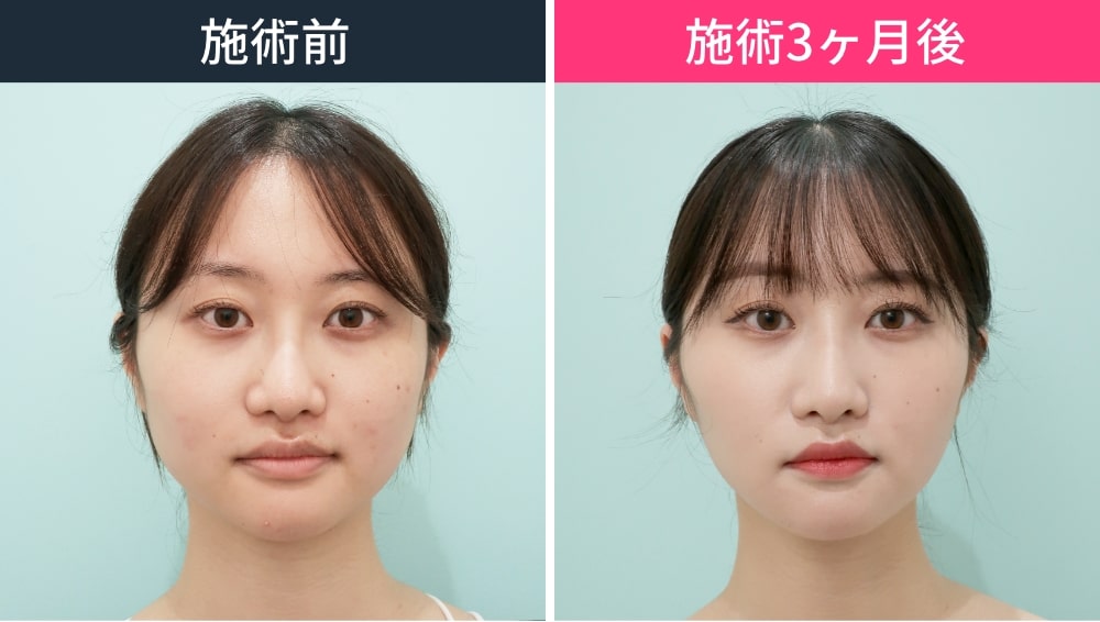 顔の脂肪吸引とエラボトックスを組み合わせた症例写真