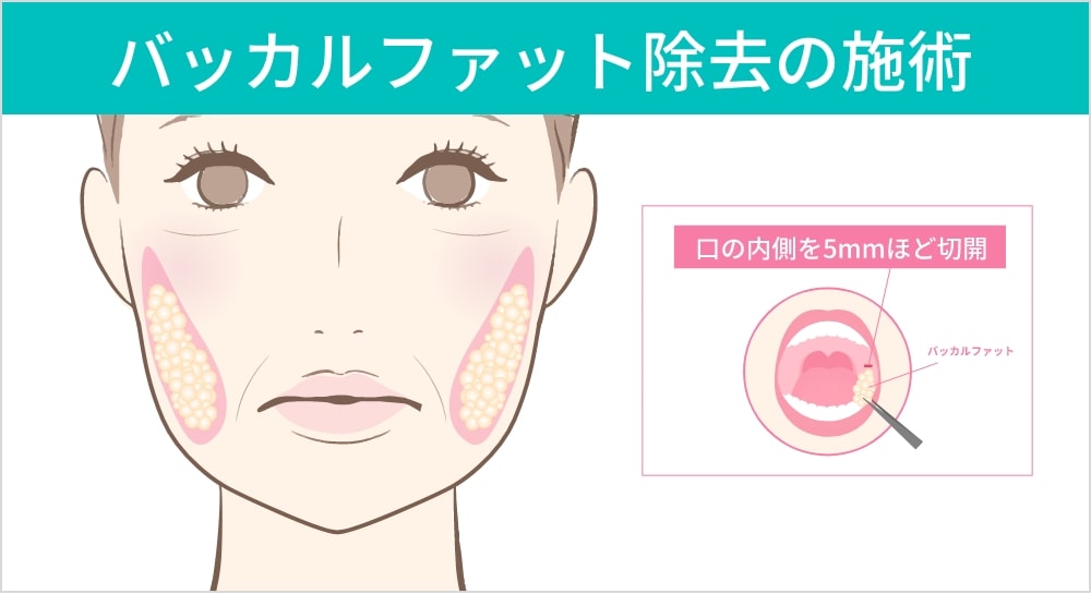 頬の脂肪を希望する方におすすめするバッカルファット除去の説明図