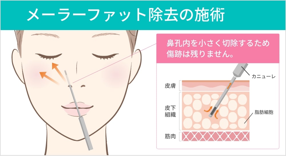 頬骨の脂肪を希望する方におすすめするメーラーファット除去の説明図