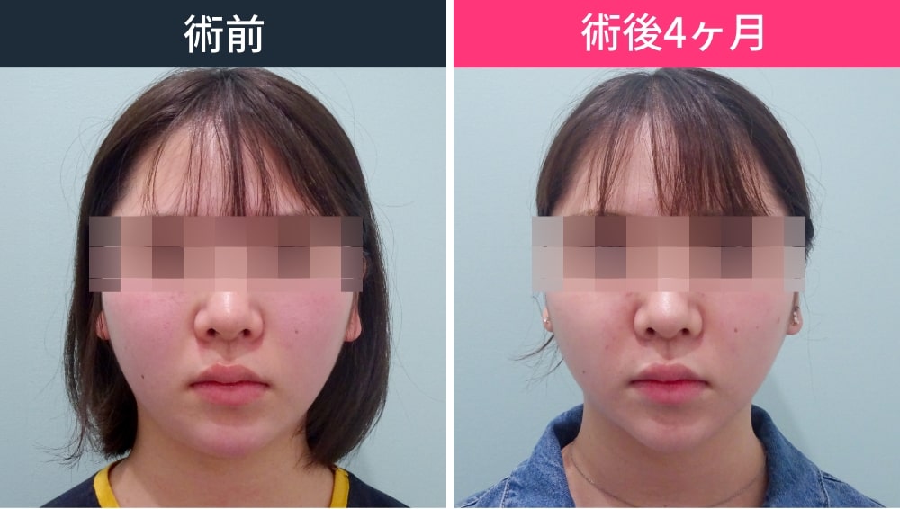 顔の脂肪吸引で効果が感じられず再施術した症例写真
