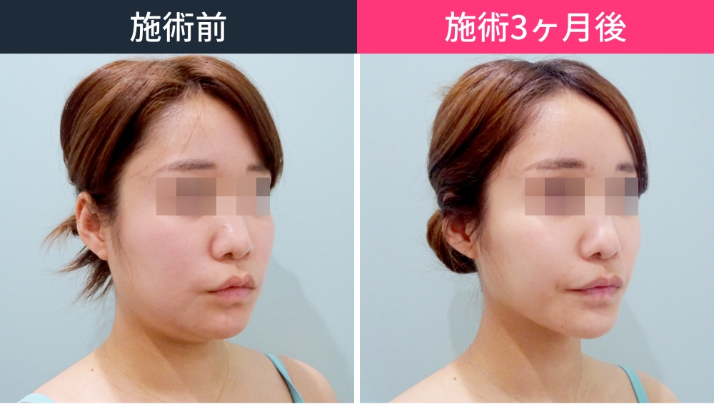 【頬・顎下】顔の脂肪吸引とエラボトックスで別人級に変化した症例写真