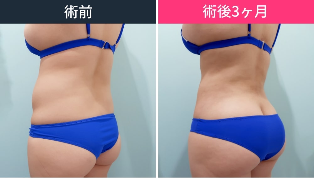 【お腹・腰・背中】他院では難しい5L超えの脂肪吸引の症例写真