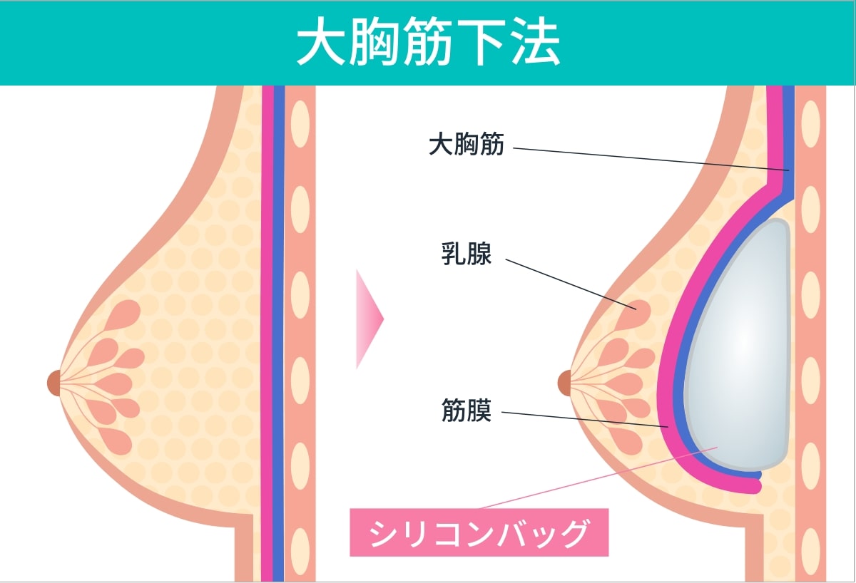 大胸筋下法を説明する図