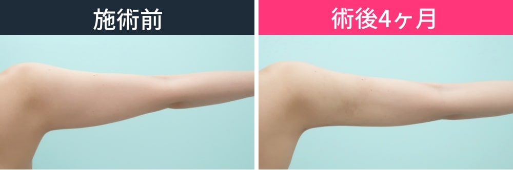 腕を上げると二の腕上部の変化がわかりやすく変化の症例写真