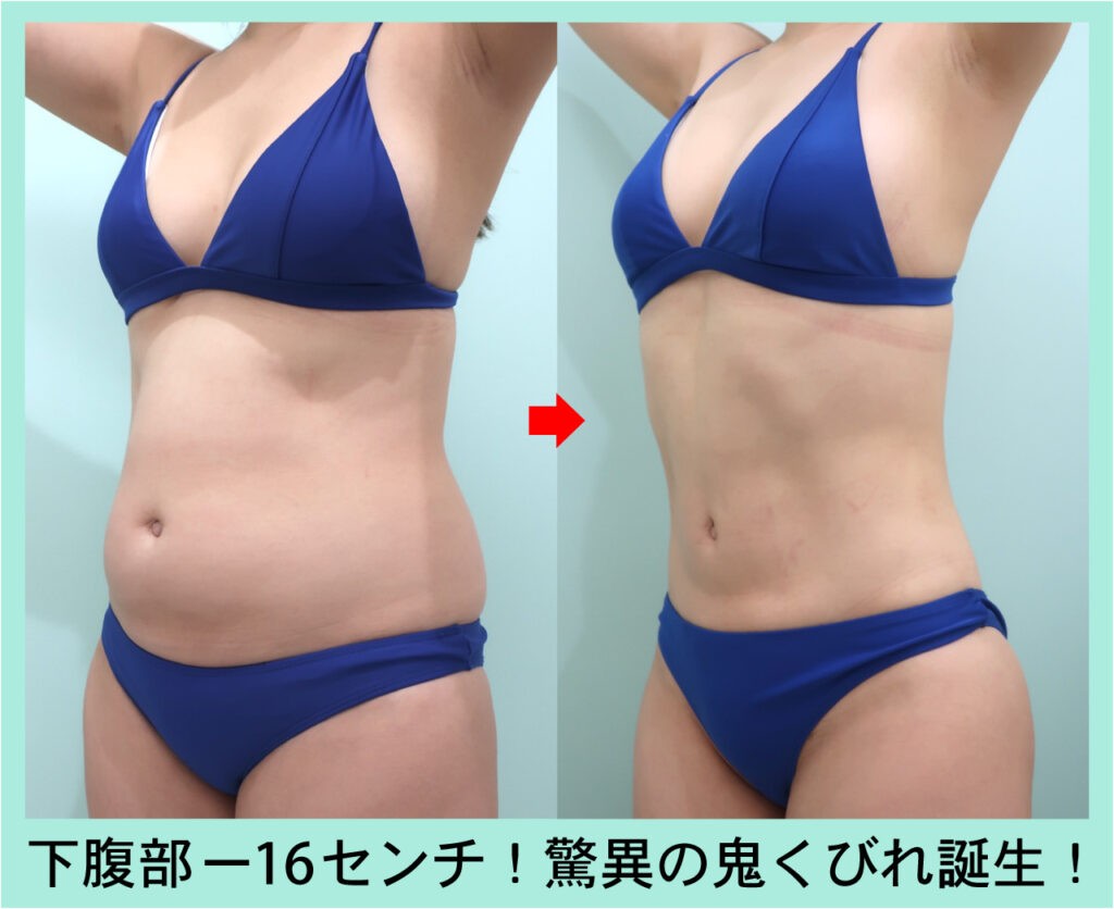 腹部脂肪吸引のビフォーアフター