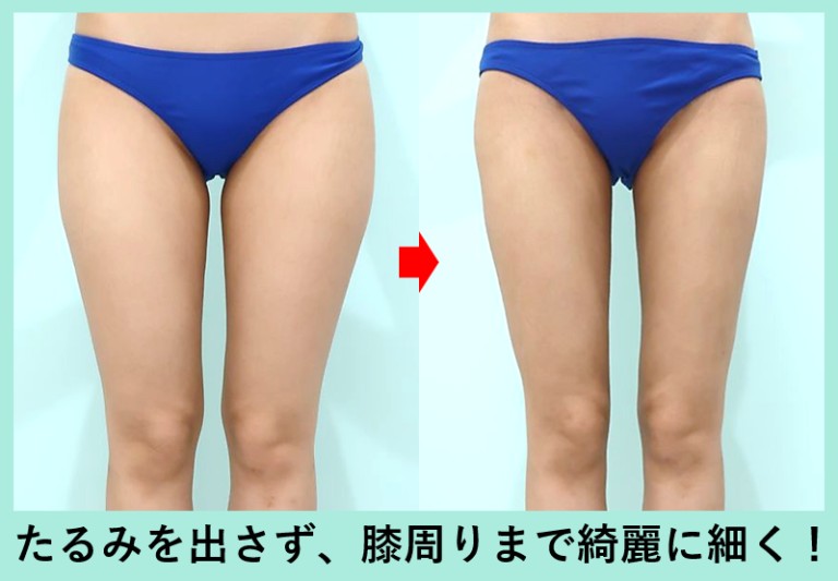 太もも脂肪吸引のビフォーアフター