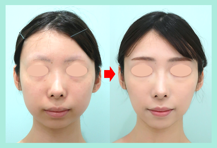『バッカルファット除去を組み合わせた小顔治療でしっかり変化！』の画像