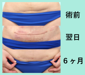 帝王切開の傷跡とタミータック手術後の傷跡