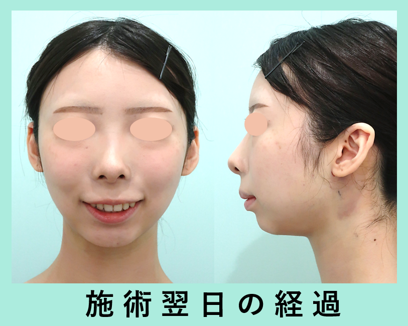 『バッカルファット除去を組み合わせた小顔治療でしっかり変化！』の画像