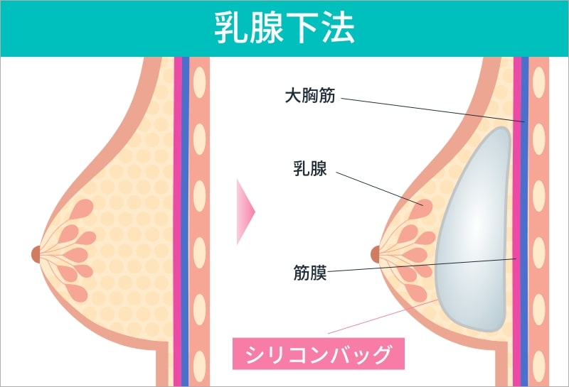 乳腺下法の説明図