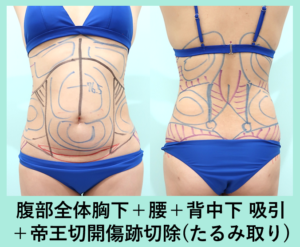 タミータック手術のデザイン