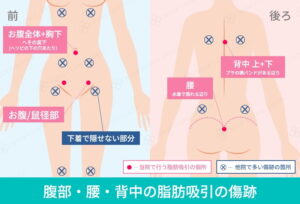 腹部腰背中の脂肪吸引傷跡の箇所